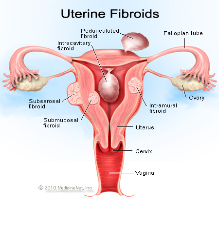 EFFECTIVE HERBAL/NATURAL REMEDY FOR FIBROID IN NIGERIA