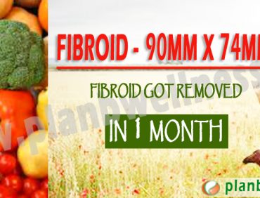 FIBROID – 90MM X 74MM FIBROID GOT REMOVED IN ONE MONTH