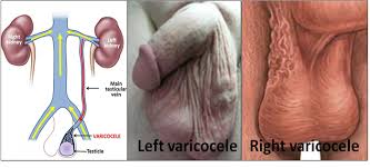 Varicocele remedy plan b wellness