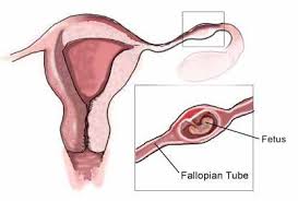 ECTOPIC PREGNANCY