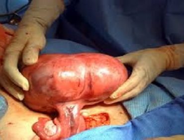 BE CAREFUL WITH FIBROID SURGERY – REAL LIVE EXAMPLES!