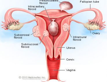 4 MAIN REASONS WHY YOU’RE STILL STRUGGLING WITH FIBROIDS