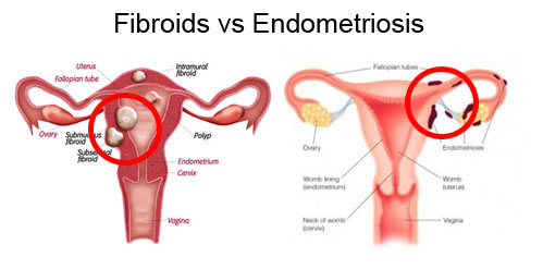 FIBROIDS AND ENDOMETRIOSIS: WHAT IS THE DIFFERENCE?