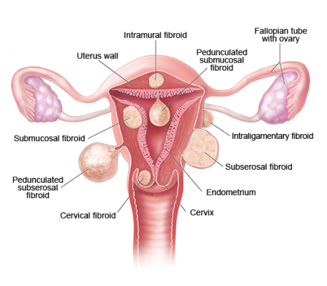 EFFECTIVE HERBAL/NATURAL REMEDY FOR FIBROID IN NIGERIA
