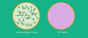 Azoospermia (No Sperm)