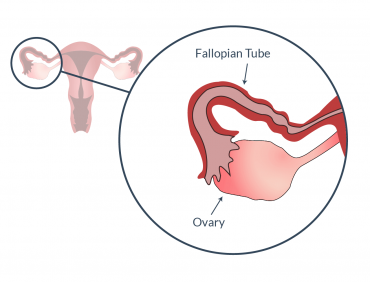 IS OVULATION POSSIBLE WITH BLOCKED FALLOPIAN TUBES?