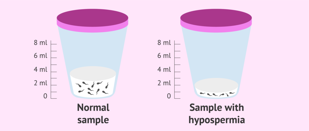 Low Semen Production (Hypospermia)