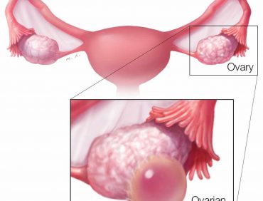 OVARIAN CYSTS: CAUSES, SYMPTOMS AND TREATMENTS