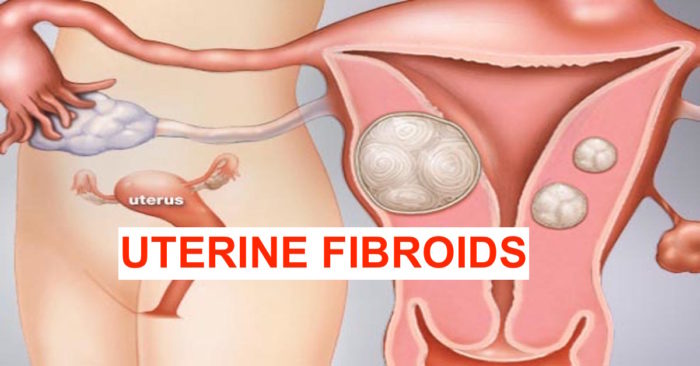 NATURAL HERBAL REMEDY FOR FIBROID