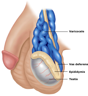 Varicoceles