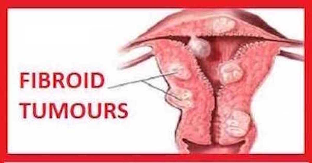 UTERINE FIBROID: CAUSES, SYMPTOMS AND NATURAL REMEDY