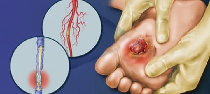 Nerve Damage (Neuropathy) caused by diabetes