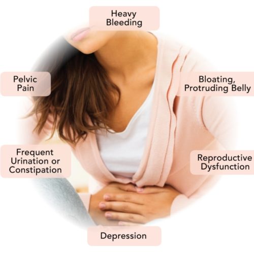 Fibroid symptoms