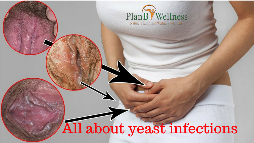 ALL ABOUT YEAST INFECTIONS