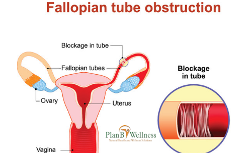 HOW DOES FALLOPIAN TUBE BLOCKAGE AFFECTS FEMALE FERTILITY