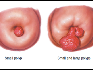 WHAT ARE CERVICAL POLYPS?