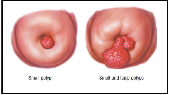 WHAT ARE CERVICAL POLYPS?