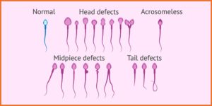 Abnormal Sperm (Morphology issues)
