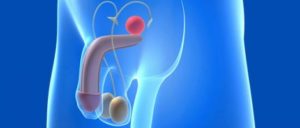 male infertility infection