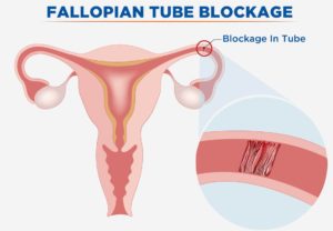 Damages to fallopian tubes
