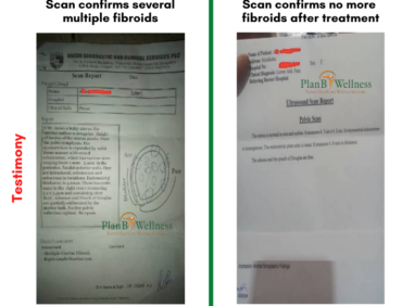 Multiple Fibroids Cleared off Totally After Taking Natural Remedy