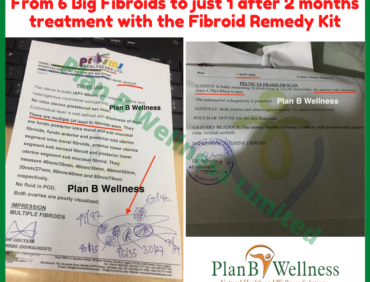 From 6 Big Fibroids to 1 after 2 months of Treatment – Scan Reports Inside