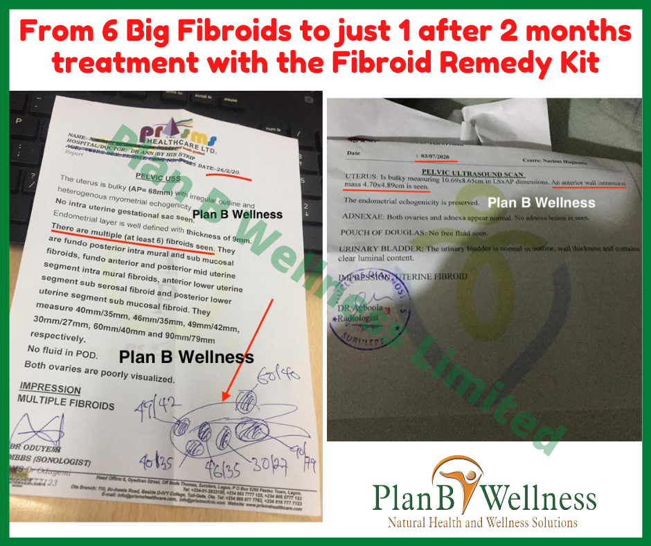 From 6 Big Fibroids to 1 after 2 months of Treatment – Scan Reports Inside