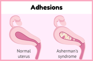 Asherman's Syndrome