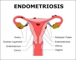 endometriosis