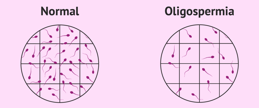 Low-Sperm-Count-Oligospermia