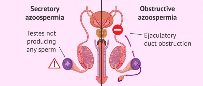 secretory or non obstructive azoospermia