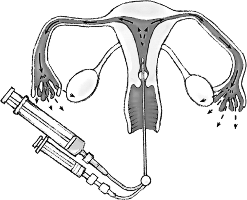 hydrotubation surgery