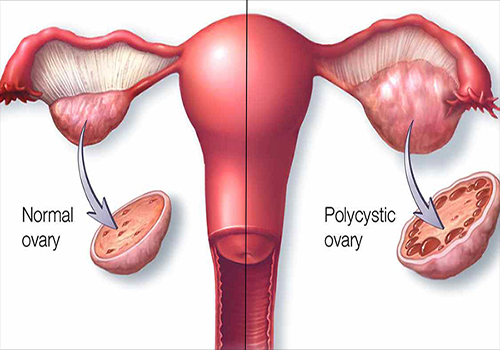 PCOS