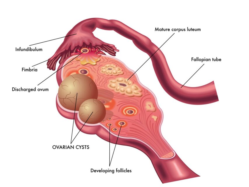 Ovulatory Disorder