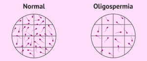 natural remedy for Low Sperm Count (Oligospermia)