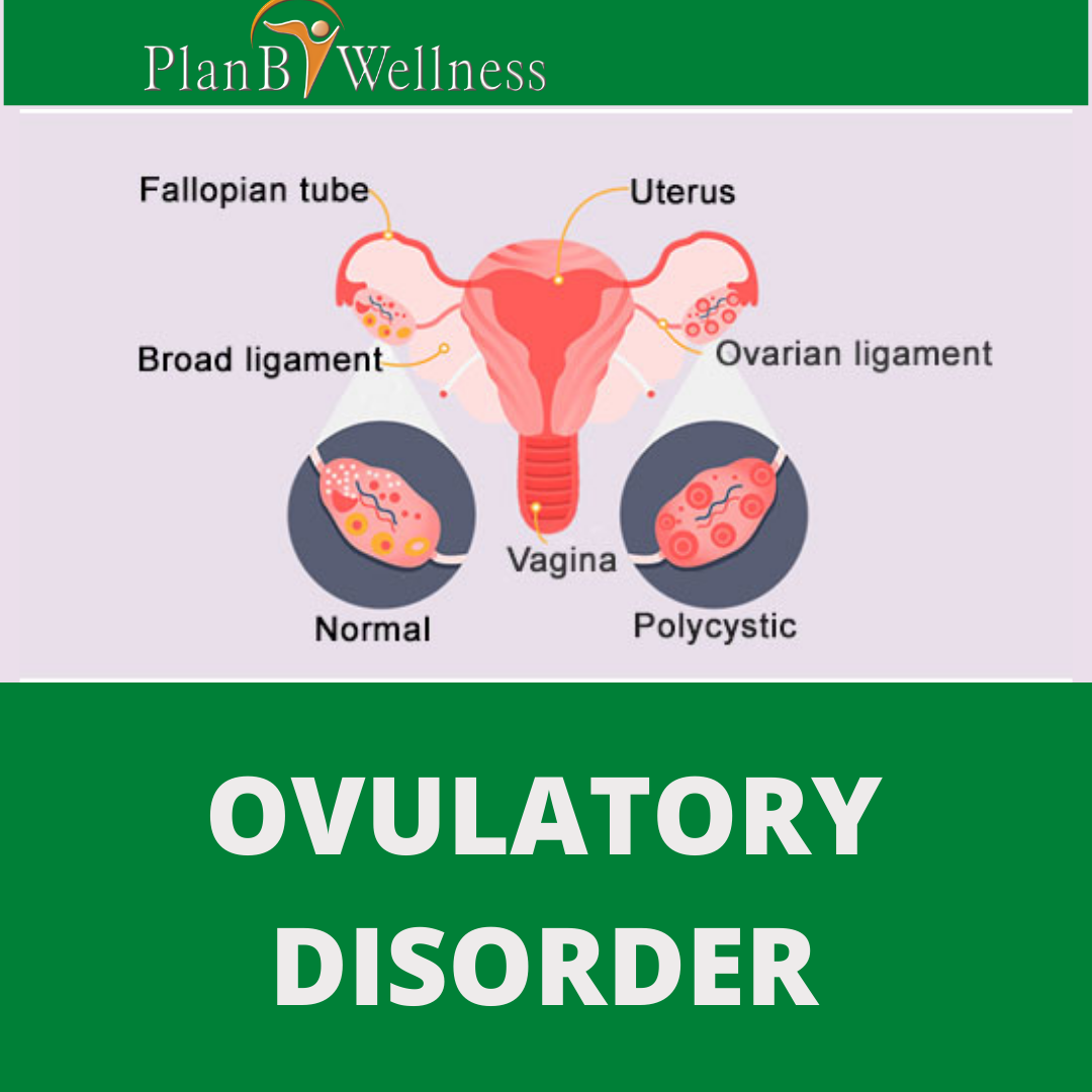 OVULATORY DISORDER; CAUSES, SYMPTOMS, INFERTILITY AND TREATMENT