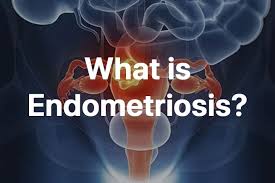 What is Endometriosis