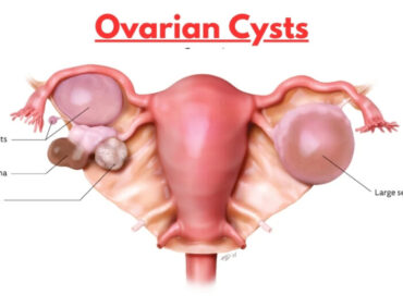 Healing Ovarian Cysts Naturally: A Fertility-Focused Approach That Works